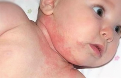 Атопический дерматит у младенца